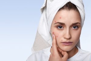 urutan skincare untuk kulit berjerawat